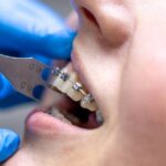 Ortodonti Nedir